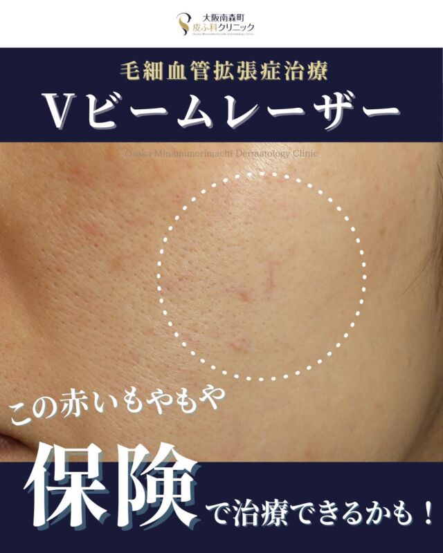 【Vビーム-毛細血管拡張症治療-】
本日は、当院で毛細血管拡張症に対してVビームでの治療をされた患者さまの経過写真をご紹介します。

Vビームはヘモグロビンに吸収されるレーザーで、赤みを伴う様々なお悩みに効果が期待できます。疾患によっては保険適応で照射が可能なものもございます。

この患者さまは、毛細血管拡張による赤みに対してVビームを１回照射したことで、頬や鼻周りの透けて見えていた血管が目立ちにくくなりました。
お肌の赤みでお悩みの方は一度当院へご相談ください。

＜保険適応疾患＞
・毛細血管拡張症
・単純性血管腫
・苺状血管腫など
※ニキビ跡の赤みなどは自費診療での治療となります。

＜費用＞
適応疾患や年齢、照射面積、負担割合によって異なります。
3割負担の場合、自己負担額は20㎠以下で約9.640円、30㎠以下で約11.140円となります。
別途初再診料や処方箋料等が必要です。
※２回目以降も保険適応で治療を受ける場合、前回照射日から一定期間を空ける必要がございます。詳しくはクリニックでお問い合わせください。
※自費診療でのVビーム治療は費用が異なります。

写真の掲載に際しまして、モニターご協力をいただきました患者さまには心より感謝申し上げます。

#Vビーム　#毛細血管拡張症　#赤ら顔　#大阪南森町皮ふ科クリニック