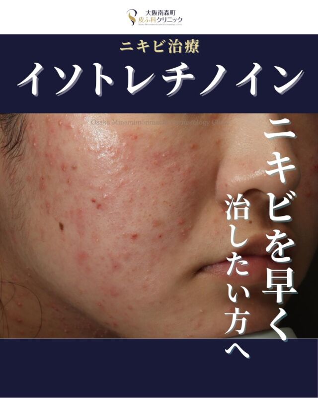 .
.
【ニキビを早く治したい方へ】
本日は、イソトレチノインを内服中の方で早期に著明にニキビが改善した患者様の経過写真をご紹介します。
この患者様は、中学生の頃から外用薬で治療をしてきた患者様でニキビの改善が乏しく、当院を受診されました。
イソトレチノインを現在3か月目を内服しており、顔から首にかけてのニキビが内服開始後1か月頃から大幅に改善しました。イソトレチノインは早期にニキビを改善したい方にはとてもお勧めの治療ですが、1クール（半年間）内服を続けて頂くことで今後数年間のニキビの再発も防ぐことができます。

ニキビでお悩みの方は内服以外でも治療法がいくつかあるのでお気軽にご相談下さい。

費用：イソトレチノイン20mg30日分　¥16.500
※体重により適正量が異なります。

#イソトレチノイン #ニキビ治療 #大阪南森町皮膚科クリニック