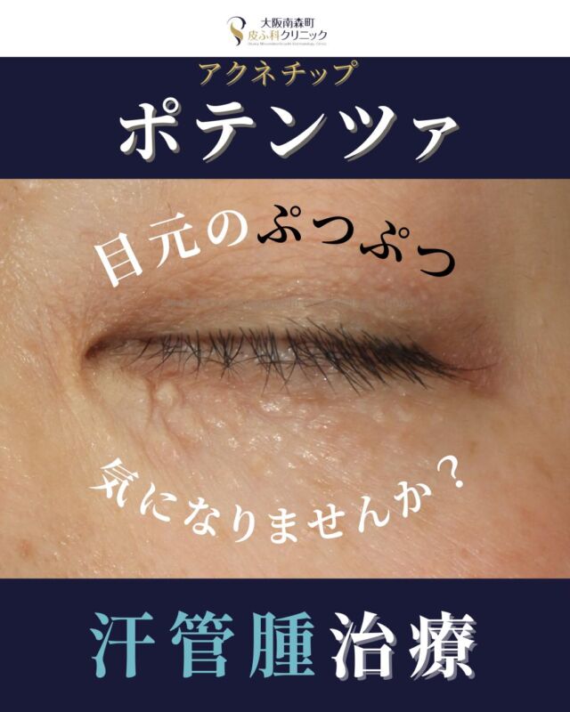 【ポテンツァ(アクネチップ)汗管腫治療】

本日は、ポテンツァ（アクネモード）で汗管腫を治療された患者さまの経過写真をご紹介します。
汗管腫とは下まぶたに好発する1〜3mm程度の良性のできものです。
アクネモードを計3回施術したところ、治療前と比較し、目元のぷっぷつが目立ちにくくなりました。
アクネモードは1本の針にRFエネルギーを集中させ、直接熱を伝達させることでにきびだけでなく汗管腫や脂腺
増殖症などをピンポイントで治療することが可能です。
＜費用＞
ポテンツァ アクネモード
汗管腫治療
目周り 1回¥29,700
※自費診療の初再診料が別途かかります。
写真の掲載に際しまして、モニターご協力をいただきました患者さまには心より感謝申し上げます。

#汗管腫#ポテンツァ#大阪南森町皮ふ科クリニッ
ク