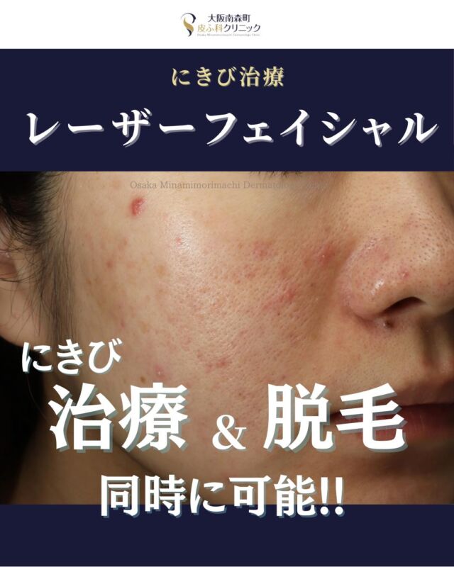 【レーザーフェイシャル-にきび治療-】
本日は、当院でにきびに対してレーザーフェイシャルで治療をされた患者さまの経過写真をご紹介します。

レーザーフェイシャルは脱毛のレーザー（アレキサンドライトレーザー）を高出力で照射することでにきびの炎症を抑える効果、脱毛効果、シミやくすみを取る効果、毛穴の引き締め効果があります。

この患者さまは、レーザーフェイシャルを計3回照射したことで、繰り返すにきびの改善だけでなく、赤みの軽減、肌全体のトーンアップもみられました。
必要な治療回数や効果には個人差がありますが、3-5回継続して治療することでより効果を実感していただけます。
肌質や症状に合わせて治療をご提案いたしますので、まずはご相談ください。

＜費用＞
レーザーフェイシャル
1回　￥16,500
※別途初診料、再診料がかかります。

写真の掲載に際しまして、モニターご協力をいただきました患者さまには心より感謝申し上げます。

#ニキビ　　#ニキビ跡　#レーザーフェイシャル　#顔脱毛　#大阪南森町皮ふ科クリニック