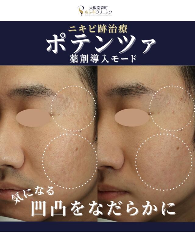 .
【ニキビ跡の凹凸をなだらかに】
 本日はニキビ跡の凹凸にポテンツァ・薬剤導入モードを施術された患者様の症例写真をご紹介します。 

この患者様は、学生の頃からニキビを繰り返しており、現在はその部分がニキビ跡となりお悩みでした。

 当院での治療として、
 ポテンツァ・薬剤導入モードを2回施術し、肌表面がなめらかになり、凹凸が目立ちにくくなりました。残ったなだらかなニキビ跡に対して、現在も治療を継続中です。

 ニキビの炎症が強い場合、治った後に凹凸の跡が残ってしまうことがあります。その場合、早い段階での治療が大切です。

また、当院のニキビ跡治療の新プランとして、ポテンツァ・薬剤導入モードのニキビ跡部分集中プランが追加になりました。従来の全顔モードと違い、ニキビ跡の部位を集中的に照射するため部分的にニキビ跡が気になる方や費用を抑えてニキビ跡治療を行いたい方におすすめです。

ご興味がある方はご相談下さい🌿

 ＜費用＞
【 ポテンツァ・薬剤導入モード全顔】
 1回：￥71.500
 3回：￥199.100（1回あたり66.367円）

【 ポテンツァ・薬剤導入モード部分集中プラン】
2回：￥99.000（1回あたり49.500円）
4回：￥159.200（1回あたり39.800円）
※全顔の1/3以下の範囲が目安です。

 ※薬剤代・麻酔クリーム代込み 
　その他、初再診料がかかります。

#ニキビ跡 #ポテンツァ #大阪南森町皮膚科クリニック