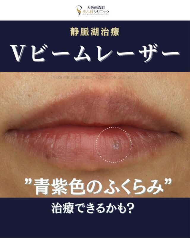 .
.
【Vビーム-静脈湖治療-】
本日は、当院で唇の静脈湖に対してVビームで治療をされた患者さまの経過写真をご紹介します。

静脈湖は、顔や唇、耳などにできる青紫色のふくらみで、加齢や紫外線、外傷（唇を噛むなど）が原因とされています。特に下唇に発症しやすく、徐々に大きくなることもあります。

当院での治療として、
Vビームを1回照射し、下唇の静脈湖が大幅に目立ちにくくなりました。
必要な治療回数や効果には個人差があります。

お悩みあればお気軽にご相談ください🍃

＜費用＞
Vビーム1回
静脈湖１個：￥11,000（税込）

#vビーム #静脈湖 #大阪南森町皮膚科クリニック