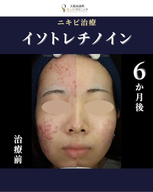 【イソトレチノイン内服】

本日は、当院でニキビ治療をされている患者さまの経過写真をご紹介します。
まずは保険診療の内服、外用から開始しましたが、少し改善するものの、再発を繰り返す状態でした。
人生における大切なイベントを半年後に控えておりそこまでにできる限りにきびを改善させたいとのお気持ちがあり、イソトレチノインを１クール（6か月）内服しました。

6か月の経過で大幅ににきびが改善し、治療前と比べ、皮脂分泌も明らかに減少し毛穴も目立ちにくくなられました✨

＜費用＞
イソトレチノイン20mg　30日分￥16,500（税込）
※体重により適正量が異ります。

※自費診療の初再診料が別途かかります。

写真の掲載に際しまして、モニターご協力をいただきました患者さまには心より感謝申し上げます。

#ニキビ　#ニキビ治療 #イソトレチノイン #Vビーム　#大阪南森町皮ふ科クリニック