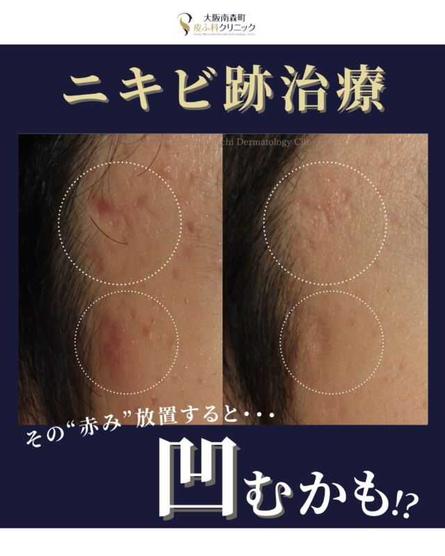 【ニキビ跡治療】
本日は、ニキビ跡の治療経過の比較症例をご紹介します。

ニキビがひどくなると、肌の奥まで傷ついて、跡が残ってしまうことがあります。
 当院では、ニキビを治すだけでなく、「跡を残さないこと」も大切にしています。
そのため、ニキビが治った後に赤みが出てきたら、なるべく早めにレーザー治療を始めることをおすすめしています。
 「ニキビはよくなったけど、跡が消えない…」とならないように、早めの治療が大切です。

どんな治療が自分に合っているか分からない方も、一度当院へご相談ください。

＜費用＞
・Vビーム《全顔》　￥19,800
（税込み）
※別途初診料、再診料がかかります。

写真の掲載に際しまして、モニターご協力をいただきました患者さまには心より感謝申し上げます。

#大阪南森町皮ふ科クリニック #ニキビの赤み　　#ニキビ跡　#クレーター　#Vビーム