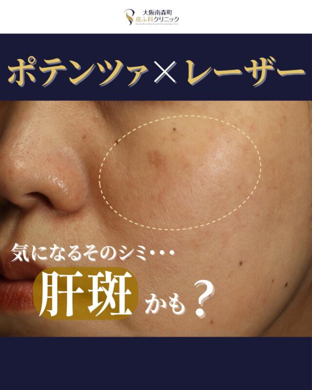 本日は、当院で肝斑治療を受けられた患者様の症例写真をご紹介します。
この患者様は、両頬の肝斑が気になりご来院されました。
1年ほど前に他院でシミ取りレーザーを受けた後から、肝斑の悪化を感じるようになったとのことでした。

当院では、ポテンツァ肝斑モードとシミ取り美白セット（トーニング+エレクトロポレーション）を月1回ずつ交互に実施し、計3回ずつご継続いただきました。
さらに、内服としてシナール（ビタミンC）・トラネキサム酸）を併用し、内側からもケアを行いました。

その結果、肝斑やくすみが大きく改善し、お肌全体がトーンアップ。
加えて、目元のちりめんジワもふっくらとし、全体的にハリのある明るい印象のお肌へと変化しました。

※治療回数や効果の実感には個人差があります。

肝斑やくすみは、肌の状態やご自宅でのケアの影響も受けやすいため、治療とあわせて日常のスキンケアや内服ケアも大切です。
お肌の色ムラ、肝斑、目元の小ジワが気になる方は、お気軽にご相談ください。

＜費用＞
●シミ取り美白セット（トーニングまたは美肌レーザー
+エレクトロポレーション）
1回
¥18,700
3回
¥53,350
5回
¥86,350

⚪️ポテンツァ肝斑モード（麻酔込み）
1回
¥38,500
3回
¥107,800
※いずれも別途、初再診料がかかります。

写真の掲載に際しまして、モニターご協力をいただきました患者様には、心より感謝申し上げます。

#シミ取り #肝斑#くすみ改善#目元のしわ#トラネキサム酸#シナール#ユベラ ＃内服治療＃肌トーンアップ
#大阪南森町皮膚科クリニック #症例紹介