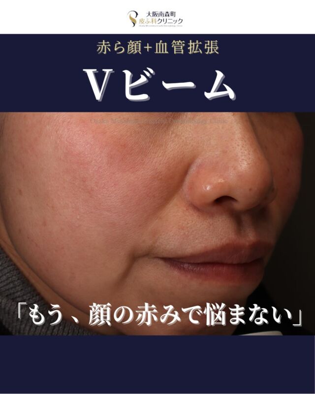 .
.
【赤ら顔治療】
本日は、幼少期から顔の赤みがお悩みの方の症例をご紹介します。
過去に他院でVビーム治療を2回受けられましたが、痛みが強く継続が難しかったため、別の治療法をお探しの中、当院を受診されました。

当院では、出力を調整し、痛みを軽減しながらVビームを照射しました。計4回のVビーム照射で、 顔の赤みが大幅に改善しました✨

赤ら顔や肌の赤みでお悩みの方はお気軽にご相談ください🌿
――――――――――――
〈費用〉
・Vビーム（全顔）1回 ￥19,800～
※別途、初診・再診料がかかります
――――――――――――
写真の掲載に際しまして、モニターご協力をいただきました患者さまには心より感謝申し上げます。

#赤ら顔 #酒さ #Vビーム#大阪南森町皮ふ科クリニック