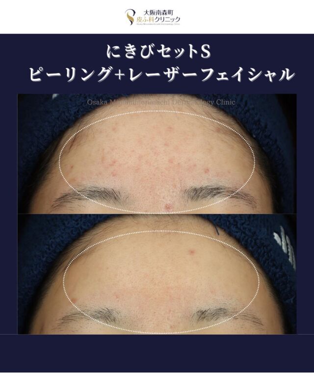 【にきびセットS】
本日は、サリチル酸ピーリング＋レーザーフェイシャルによる《にきびセットS》で治療を受けられた患者さまの経過写真をご紹介いたします。

サリチル酸ピーリングで古い角質や毛穴詰まりを取り除いたあとの整った肌に、同日でレーザーを照射することで、相乗的な治療効果が期待できます。

今回ご紹介する患者さまは、にきびセットSを5回受けていただきました。
 繰り返しできていたにきびの改善に加え、毛穴の引き締まりといった効果も見られ、肌全体の質感が向上しています。

当院ではにきびの重症度やお肌の状態・お悩みに応じて、最適な治療をご提案いたします。まずはお気軽にご相談ください🌿

＜費用＞
にきびセットS全顔《サリチル酸ピーリング+レーザーフェイシャル》
1回　￥21,560
2回　￥39,600
3回　￥53,240
※別途初診料、再診料がかかります。

写真の掲載に際しまして、モニターご協力をいただきました患者さまには心より感謝申し上げます。

#大阪南森町皮ふ科クリニック　#ニキビ治療　#ピーリング　#レーザー　#美容皮膚科