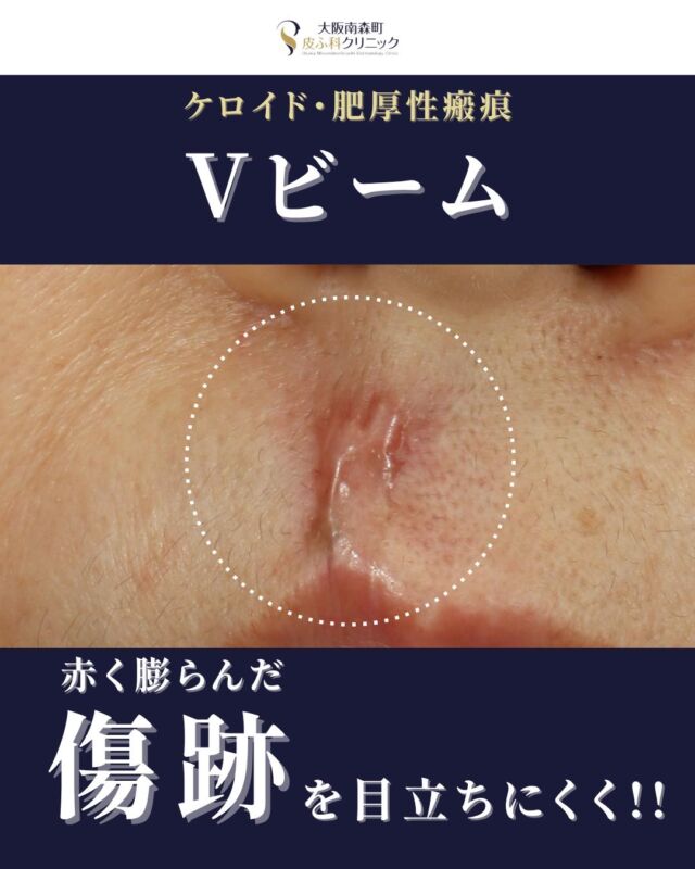 【ケロイド・肥厚性瘢痕の治療症例】
けがや手術の後や、炎症の強いにきびの後に傷跡が盛り上がって残ってしまうことがあります。これを「ケロイド」や「肥厚性瘢痕（ひこうせいはんこん）」といいます。
今回は、そのような盛り上がった傷跡の症例をご紹介します。
この方は、まずは保険治療で傷の盛り上がりや硬さを和らげる「ケナコルト」という注射を計3回施行し、盛り上がりが少し改善しましたが、赤みが残ったため自費治療に切り替え、赤みを目立ちにくくする「Vビーム」というレーザーを計5回受けられ、傷跡の盛り上がりも、赤みもかなり改善しました。
瘢痕（傷跡）の状態にあわせて、治療のタイミングや量を調整しながら治療を行っています。
盛り上がった傷跡にお悩みの方は、ぜひ一度ご相談ください。

＜費用＞
Vビーム（肥厚性瘢痕　～10㎠）1か所　1回￥11,000～（税込）

※初診・再診料別途必要

#肥厚性瘢痕　#傷跡治療　#Vビーム　#ケナコルト注射　#ケロイド　#大阪南森町皮ふ科クリニック