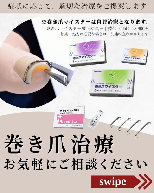 【巻き爪でお悩みの方へ】
痛みを我慢していませんか？
当院では、爪に専用の器具を装着して行う巻き爪矯正治療「巻き爪マイスター」を行っています。
器具の力で巻き爪を少しずつ広げていき、痛みや食い込みの改善を目指します。
巻き爪による痛みやトラブルでお困りの方は、まずはお気軽にご相談ください。

＜料金＞
※巻き爪マイスターは自費治療となります。
・巻き爪マイスター矯正器具＋手技代（1）：8,800円
・調軽代：2,200円／回
・リネイルゲル：5,500円
※診察や処方がある場合、別途料金がかかります。

#巻き爪　#巻き爪マイスター #大阪南森町皮膚科クリニック
