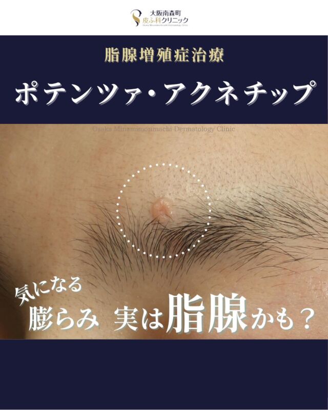 【脂腺増殖症治療】
本日は、脂腺増殖症に対してポテンツァ・アクネチップで治療を行った患者さまの症例写真をご紹介いたします。

脂腺増殖症とは、皮脂腺が過剰に増殖することで皮膚が盛り上がってできる良性の腫瘍です。健康上の問題はありませんが、自然に消えることはなく、見た目が気になるという理由でご相談いただくことが多くあります。

今回の患者さまは、左眉上の脂腺増殖症に対してポテンツァ・アクネチップを3回施術しました。治療後は、ふくらみも赤みもかなり目立ちにくくなりました。

＜費用＞
ポテンツァ・アクネモード 1回
 ・1～5個　¥15,950
 ・6～10個　¥19,800
 ・11～15個　¥24,200
 ・15個以上　¥要相談

気になる症状がございましたら、お気軽にご相談ください🌿