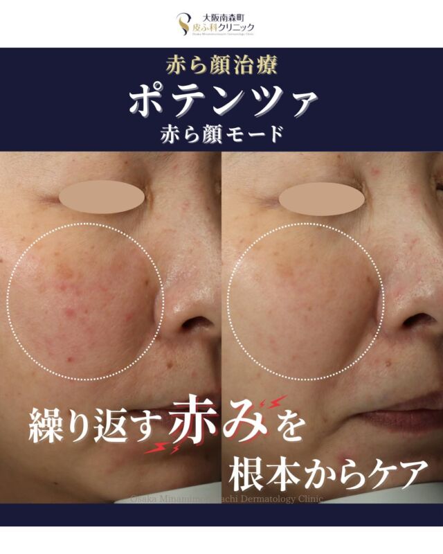 【ポテンツァ　赤ら顔モード】
本日は、赤ら顔のお悩みでご来院された患者さまのポテンツァ治療経過をご紹介いたします。
赤ら顔は、体の内側や外側からの刺激で炎症が起き、それによって新しく血管が増えることで、赤みが強くなります。
ポテンツァ〈赤ら顔モード〉では、毛細血管のある真皮層へ直接高周波を照射することで、赤ら顔の原因となる新生血管を抑制し、根本からアプローチすることが可能です。
今回ご紹介する患者さまは、同モードで3回の治療を受けられ、赤みの軽減がみられました。
当院では、お肌の状態やお悩みに応じて最適な治療法をご提案しております。まずはお気軽にご相談ください🌿
――――――――――
＜治療費用＞
【8/31まで】のキャンペーン価格（麻酔クリーム代込み）

ポテンツァ〈毛穴・赤ら顔・肌質改善モード〉
1回　通常￥38,500 → ￥32,725
3回　通常￥107,800 → ￥91,630

※別途、初診料・再診料がかかります
――――――――――

写真の掲載に際しまして、モニターご協力をいただきました患者さまには心より感謝申し上げます。

#大阪南森町皮ふ科クリニック #赤ら顔治療 #ポテンツァ #美容皮膚科 #毛細血管 #RF治療 #肌質改善