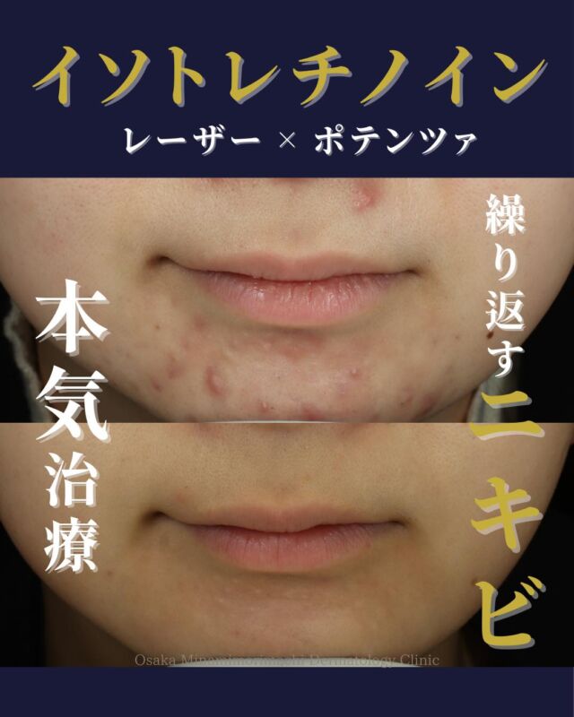 .
.
【繰り返すニキビ治療】
本日は、繰り返すニキビに対してイソトレチノイン+各種レーザー治療をされた患者さまの症例写真をご紹介します。
この患者さまは、中学生頃からにきびを繰り返しており、顎のニキビがなかなか改善されないため、当院を受診されました。

皮脂量が多いため、イソトレチノインを6カ月間内服。その後、ニキビの再発予防や残ったニキビ跡の赤みに対してニキビセットW（レーザーフェイシャル+Vビーム）や美肌レーザーを行いました。ニキビの再燃は落ち着いており赤みも大幅に改善しました。現在は、ニキビ跡のクレーターに対してポテンツァ部分集中モードにて治療を継続されています。

にきびでお悩みの方は、ぜひご相談下さい🍁

＜費用＞
●イソトレチノイン20mg　30日分　￥16,500
（※体重により適正量が異なります。） 
●美肌レーザー　全顔1回　￥8,800　
●レーザーフェイシャル全顔1回　￥16,500
●Vビーム全顔1回　￥19,800
●ポテンツァ（薬剤導入モード・マックーム）ニキビ跡部分集中　　　　　　　　　　2回コース　￥99,000（1回あたり￥49,500）　

写真の掲載に際しまして、モニターにご協力をいただきました患者さまには心より感謝申し上げます。 

#ニキビ治療 #イソトレチノイン #レーザー治療 #大阪南森町皮膚科クリニック