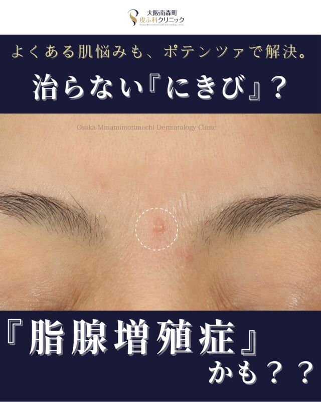【ポテンツァ(アクネモード)脂腺増殖症治療】
本日は、「眉間に昔からあるできものが気になる」という主訴で受診された患者様の脂腺増殖症に対するポテンツァ・アクネチップ治療の症例写真をご紹介します。
脂腺増殖症は、毛穴の中にある皮脂を作る脂腺が増えたできもので、原因は不明ですが加齢が大きな要因とされています。
自然に消えることはなく、外見に影響を及ぼす場合には治療の対象となります。
今回は、ポテンツァ・アクネチップを1回施術したところ、気になっていたふくらみが目立たなくなり、肌もすっきりと整いました。
ポテンツァ・アクネチップは、皮脂腺を熱で破壊することができるため、脂腺増殖症やニキビの再発予防にも効果的な治療法です。
<費用>
アクネモード
・1-5個¥15,950
•6-10個¥19,800
・11-15個¥24,200
・15個以上要相談
写真の掲載に際しまして、モニターにご協力いただきました患者様には心より感謝申し上げます。
#脂腺増殖症
#ポテンツァ
#アクネチップ
#大阪南森町皮膚科クリニック
个
