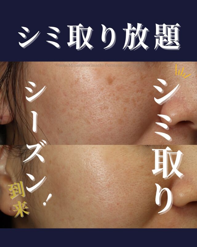 .
.
【シミ治療】
本日は当院でシミ取り放題とシミ取り美白セット(トーニング+エレクトロポレーション)を施術された患者様の症例写真をご紹介します。
この患者様は、お顔のシミとくすみが気になり、ご来院されました。
シミ取り放題により、シミが薄くなることでお顔の印象が明るくなりました!
また、取り放題の1か月後より残ったシミや肝斑に対してシミ取り美白セット(トーニング+エレクトロポレーション)を数回施術したことによりお肌もトーンUPしました✨
紫外線が落ち着いてきた時期がシミ取りのシーズンです!
お肌にお悩みがあればぜひ、カウンセリングへご来院ください🍁
<費用>
●シミ取り放題全顔:¥11,000
※その他、部位別料金あり
●シミ取り美白セット(トーニングまたは美肌レーザー+エレクトロポレーション)1回 ¥18,700
写真の掲載に際しまして、モニターにご協力いただきました患者様には心より感謝申し上げます。
#シミ取り放題 #シミ治療 #大阪南森町皮膚科クリニック