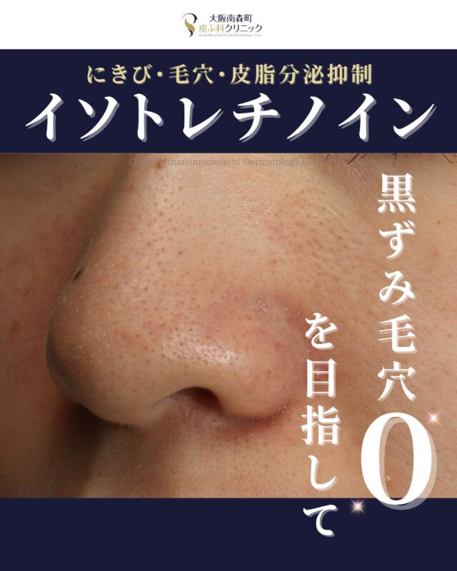 【イソトレチノイン内服-にきび、皮脂、毛穴治療】
本日は、にきび、皮脂、毛穴のお悩みに対してイソトレチノインを内服された患者様の症例写真をご紹介します。
この方は、1年間一般的なにきび外用薬(ベピオ®など)を一通り試し、低用量ピルも併用しましたが改善が乏しく当院に来院されました。
イソトレチノインを1クール6か月間内服後、にきびの改善が認められました。その後皮脂戻りや毛穴悩みに対して2クール目を6か月間追加で内服しました。それによって、酸化した角栓による黒ずみが減り、毛穴の目立ちが軽減しています。
イソトレチノインは重症ニキビの治療薬として内服されることが多い薬ですが、皮脂腺からの皮脂分泌を抑制する働きもあり、皮脂や黒ずみ毛穴の治療にも効果が期待できます。
<料金>
イソトレチノイン20mg 30日分¥16.500
※体重により適正量が異なる場合があります。
#イソトレチノイン #にきび  #毛穴 #大阪南森町皮膚科
