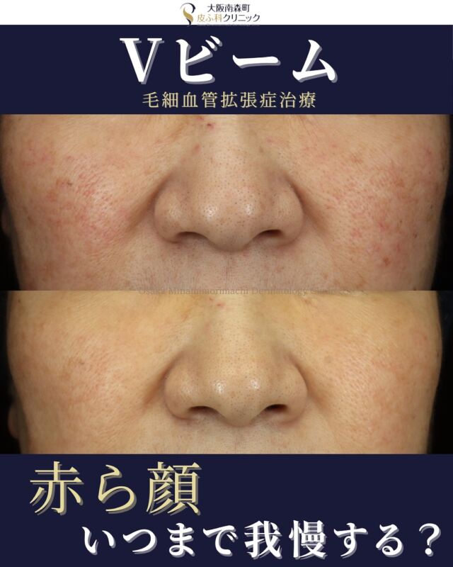 【赤ら顔治療】
持病に対する内服治療の影響で血管が拡張しやすく、両頬の赤みが改善しないとのご相談でした。
診察のうえVビームを4回実施し、赤みの目立ちが軽減しました✨
赤ら顔・酒さ様の赤みでお悩みの方は、まずはご相談ください。
※治療方法・回数・効果には個人差があります。
――――――――――――
📍Vビーム
全顔:1回 ¥19,800
両頬:1回 ¥14,850
※別途、初診・再診料がかかります
――――――――――――
写真の掲載に際しまして、モニターご協力をいただきました患者さまには心より感謝申し上げます。
#赤ら顔 #酒さ #Vビーム#大阪南森町皮ふ科クリニック