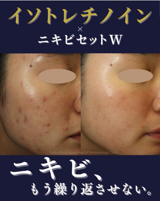 【ニキビ、ニキビ跡治療】
本日は、当院でニキビ・ニキビ跡治療をされている患者さまの症例写真をご紹介いたします。
イソトレチノイン内服開始後4か月経過後、ニキビ跡に対して「ニキビセットW」（Vビームレーザー・レーザーフェイシャル）を1クール行いました。
治療前と比較し、ニキビ・ニキビ跡が改善しています✨

ニキビ・ニキビ跡にお悩みの方、イソトレチノイン・レーザー治療に興味がある方
ぜひ一度、当院にご相談ください🍀
────────────
〈費用〉
・イソトレチノイン20mg（30日分）
16,500円（税込）
※体重により適正量が異なる場合があります。
・ニキビセットW1クール　29,700円（税込）
（Vビーム全顔1回＋レーザーフェイシャル全顔1回）
・ニキビセットW2クール　57,365円（税込）
（Vビーム全顔2回＋レーザーフェイシャル全顔2回）
※自費診療の初再診料が別途かかります。
────────────

※写真の掲載にあたり、モニターとしてご協力いただいた
患者さまに心より感謝申し上げます。

 #にきび #にきび跡 
 #イソトレチノイン 
 #レーザーフェイシャル  #vビーム 
 #美容皮膚科 
#大阪南森町皮ふ科クリニック