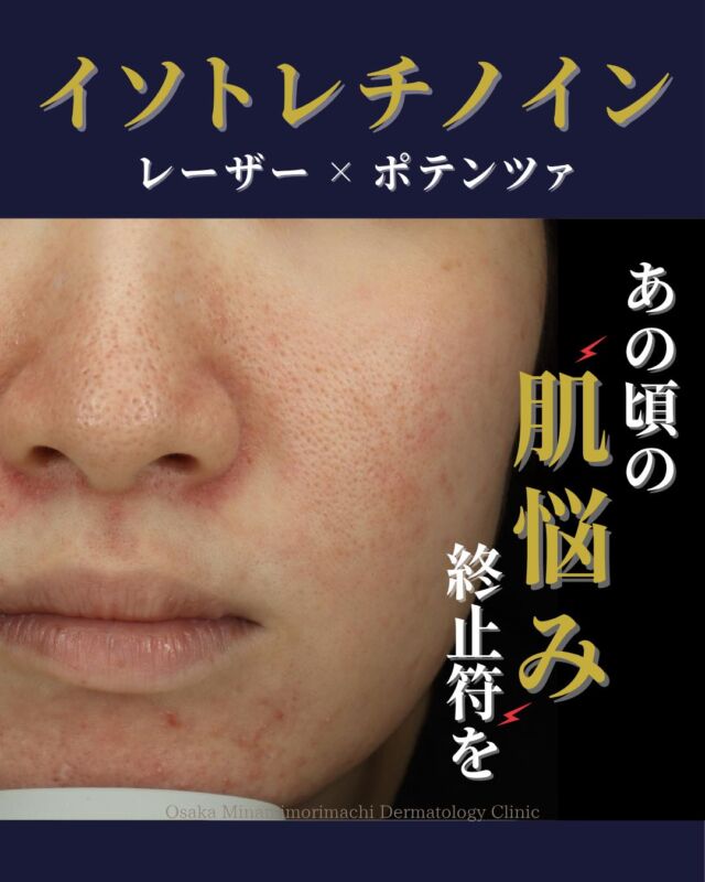 .
.
【ニキビ・毛穴・赤み治療】
本日は、イソトレチノイン内服とレーザー治療、ポテンツァによる治療を受けられた患者様の症例をご紹介します。
この患者様は、小学生の頃から繰り返すニキビに悩まれており、保険治療では十分な改善が見られず、当院を受診されました。
皮脂分泌も多く、にきびとともに毛穴の開きも気になるとのことで、まずはイソトレチノインを6カ月間内服。その後、ニキビ跡の赤みや毛穴に対してポテンツァ（毛穴・赤ら顔モード）を3回+Vビーム2回施術しています。

治療の結果、ニキビは大きく改善し、ポテンツァやVビームの併用で毛穴の引き締まりや赤みの軽減、肌全体のツヤ感の向上が見られました。

繰り返すニキビや毛穴の開き、顔の赤みでお悩みの方は、ぜひ一度ご相談ください🍁

＜費用＞
📍イソトレチノイン（20mg 30日分）：¥16,500（税込）
※適正量は体重等によって異なります。

📍Vビーム（全顔）：¥19,800（税込）※部位別メニューあり

📍ポテンツァ（毛穴・赤ら顔モード）
1回：¥38,500（税込）
3回：￥107,800（税込）

写真の掲載に際しまして、モニターにご協力をいただきました患者さまには心より感謝申し上げます。

#ニキビ治療 #イソトレチノイン #大阪南森町皮膚科クリニック