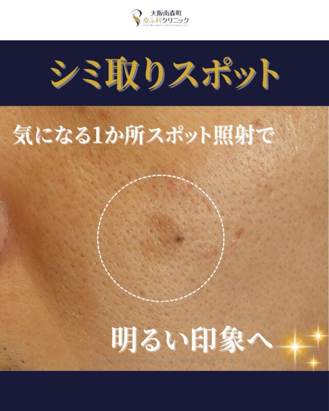 【シミ取りスポット】
本日は、シミ取りスポット照射された患者さまの２週間後の経過写真をご紹介します。
治療前と比較し、シミ取りスポット照射1回でお顔の気になっていたシミが目立ちにくくなりました✨

〈費用〉
シミ取りスポット≪1㎠未満≫￥6,600（税込）
※自費診療の初再診料が別途かかります。
〈リスク・副作用〉
 赤み・ヒリつき・一時的なかさぶた・色素沈着（個人差あり）。日焼け対策が必要です。
 ※適応の有無・必要回数はシミの種類や大きさにより異なります。医師が診察のうえご案内します。

写真の掲載に際しまして、モニターご協力をいただきました患者さまには心より感謝申し上げます。

#シミ取り #シミ取りレーザー #美容皮膚科 #大阪南森町皮ふ科クリニック