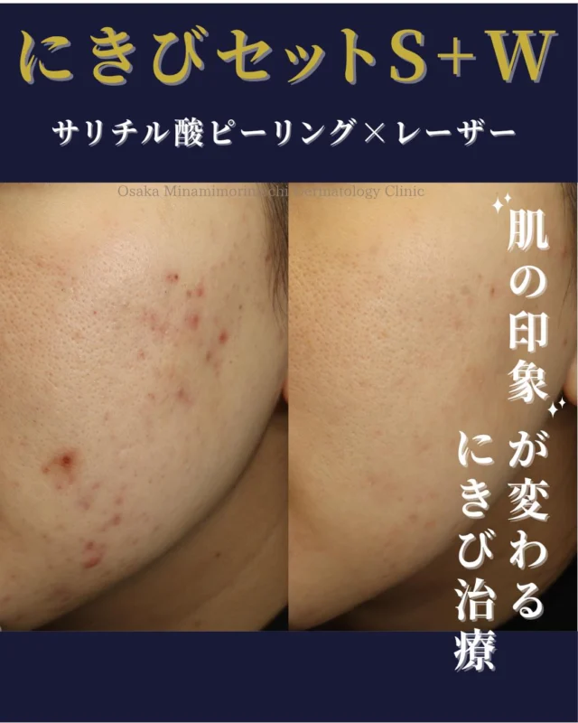 【にきび・にきび跡治療】
本日は、繰り返すにきびやにきび跡に対して治療をされた患者さまの症例写真をご紹介します。
この患者さまは、保険診療のにきび治療を受けておられましたが、再発を繰り返されていたため、にきびの自費治療への移行をご希望されました。
まずは、にきびができにくい肌状態にするために『にきびセットS（サリチル酸ピーリング+レーザーフェイシャル）』を月1回で計3回行い、その後にきびの再発予防やにきび跡の赤みに対して『にきびセットＷ（レーザーフェイシャル、Ｖビーム）』を2クール（計4か月）することで再発しやすかったにきびが治まり、にきび跡の赤みも大幅に改善しました。

レーザー等の施術はお得なセットもございます✨
にきびでお悩みの方は、ぜひご相談下さい!!

＜費用＞
・ニキビセットS全顔3回　￥53,240円
（サリチル酸ピーリング+レーザーフェイシャルを3回）
・ニキビセットW全顔2クール　￥57,365円
（Vビーム2回、レーザーフェイシャル2回）
※自費診療の初再診料が別途かかります。

写真の掲載に際しまして、モニターにご協力をいただきました患者さまには心より感謝申し上げます。

#にきび #にきび跡
#レーザーフェイシャル #vビーム
#大阪南森町皮ふ科クリニック
