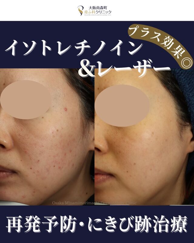 【ニキビ治療】
当院でイソトレチノイン内服とレーザー治療を併用された患者さまの症例写真をご紹介します。

患者様は他院で保険診療を長期間受けられてこられましたが、なかなか良くならないため、繰り返すにきびをなんとか改善したいとのお気持ちで当院を受診されました。

当院でイソトレチノインを6か月間内服後、「ニキビセットW」（Vビーム＋レーザーフェイシャル）を併用いただきました。
イントレチノインとレーザーフェイシャルは、どちらも“にきびをできにくくする”働きがあり、併用すると治療を進めやすい組み合わせです。

レーザーフェイシャルには脱毛効果もあり、皮脂づまりを起こしにくい肌環境に整いやすくなります。
内服とレーザーを並行して進めることで治療後の再発を防ぎやすく、
赤みが引くことで肌がきれいに見えやすい変化も期待できます。

さらに、にきびの赤みを早く落ち着かせることで、クレーターへ移行しにくい状態に整えやすくなります。

にきび・にきび跡でお悩みの方は、お気軽にご相談ください。

🎈イソトレチノイン20mg（30日分）：¥16,500（税
込）
※体重・症状により適正量が異なります

🎈ニキビセットW 
・全顔1クール（Vビーム1回／レーザーフェイシャル1回）：¥29,700（税込）
・全顔2クール（Vビーム2回／レーザーフェイシャル2
回）：¥57,365（税込）

※別途、初診・再診料がかかります

写真の掲載に際し、モニターご協力を賜りました患者さまに心より感謝申し上げます。

#レーザーフェイシャル#Vビーム#ニキビ治療#イソトレチノイン#大阪南森町皮ふ科クリニック