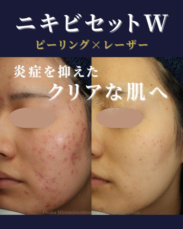 .
.
【ニキビ治療】
本日は、学生の頃からニキビにお悩みで、保険診療ではなかなか改善が見られなかった方の症例写真をご紹介します。
 
実施した施術内容は、
 ・サリチル酸ピーリング：3回
 ・美肌レーザー：3回
 ・ニキビセットW（レーザーフェイシャル＋Vビーム）：3クールです。
こちらの患者様は現在も、ニキビセットWにて治療を継続されています。
 治療を重ねることで、ニキビが大幅に改善し、お肌の印象も明るくなりました。
ニキビでお困りの方、赤みや炎症が続いている方は、ぜひ一度ご相談ください。
――――――――――――
 ＜費用＞
 📍サリチル酸ピーリング　全顔1回：¥6,600（税込）
 📍美肌レーザー　全顔1回：¥8,800（税込）
 📍ニキビセットW
 ・全顔 1クール（レーザーフェイシャル1回／Vビーム1回）：¥29,700（税込）
 ・全顔 2クール（レーザーフェイシャル2回／Vビーム2回）：¥57,365（税込）
 ※別途、初診・再診料がかかります
 ――――――――――――
写真の掲載にご協力くださりました患者様に、心より感謝申し上げます。
#ニキビ治療 #レーザー治療 #Vビーム #レーザーフェイシャル #大阪南森町皮膚科クリニック