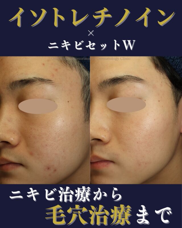 .
.
【ニキビ・ニキビ跡、毛穴治療】
本日は、当院でニキビ・ニキビ跡治療をされている患者さまの症例写真をご紹介いたします。
イソトレチノイン内服開始後4か月経過後、ニキビ跡に対して「ニキビセットW」（Vビームレーザー・レーザーフェイシャル）を2クール行いました。
治療前と比較し、ニキビ・ニキビ跡が改善しています。それに加えて皮脂が減ったことによって黒ずみ毛穴の軽減もみられます✨
イソトレチノインは、重症ニキビ治療薬として内服されることが多い薬ですが、皮脂抑制の作用もあるため黒ずみ毛穴にも効果が期待できます。

ニキビ・ニキビ跡や黒ずみ毛穴にお悩みの方、イソトレチノイン・レーザー治療に興味がある方
ぜひ一度、当院にご相談ください🍀
────────────
〈費用〉
・イソトレチノイン20mg（30日分）
16,500円（税込）
※体重により適正量が異なる場合があります。
・ニキビセットW1クール　29,700円（税込）
（Vビーム全顔1回＋レーザーフェイシャル全顔1回）
・ニキビセットW2クール　57,365円（税込）
（Vビーム全顔2回＋レーザーフェイシャル全顔2回）
※自費診療の初再診料が別途かかります。
────────────

※写真の掲載にあたり、モニターとしてご協力いただいた
患者さまに心より感謝申し上げます。

#にきび治療 #毛穴治療
#イソトレチノイン
#レーザーフェイシャルVビーム
#大阪南森町皮ふ科クリニック
