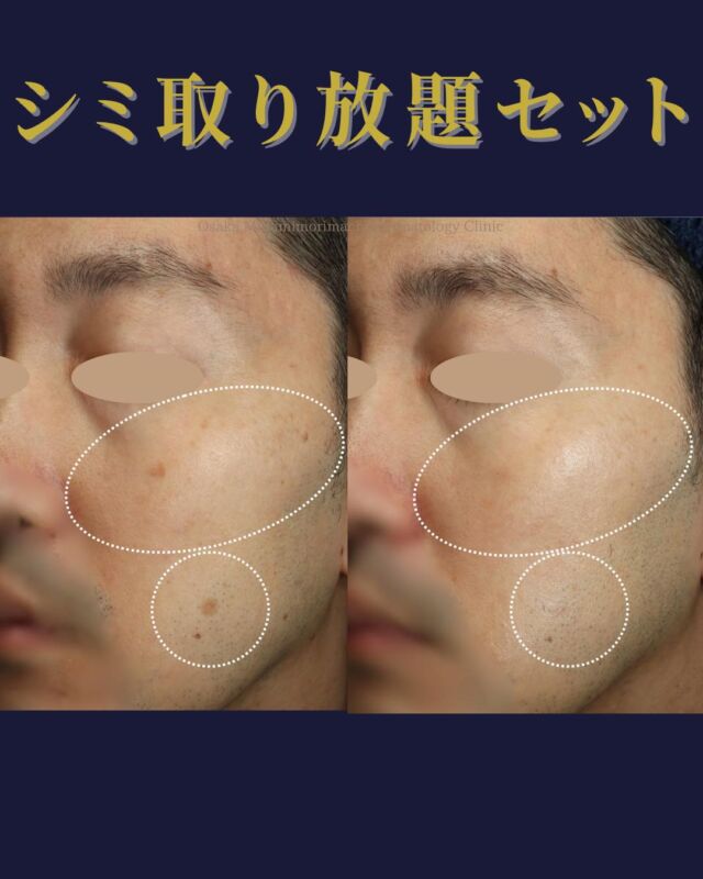 【シミ取り放題セット】

本日は、シミ取り放題＋エレクトロポレーションのセットを受けられた患者さまの施術1か月後の経過写真をご紹介します。
レーザー照射とエレクトロポレーションを行うことで、照射後の肌の鎮静や色素沈着（PIH：炎症後色素沈着）への配慮をしながら、気になっていたシミがかなり目立ちにくくなりました✨
さらに、医師の指示のもと照射後2週間頃からトラネキサム酸配合クリームを開始し、よりきれいな仕上がりにつながりました。
 ※経過には個人差があります。

――――――――――
 〈費用〉
シミ取り放題セットA　￥49,000
 ・シミ取り放題（全顔）
 ・エレクトロポレーション 3回
 ・TA含有ローション 1本
 ・美容内服 3種
シミ取り放題セットB　￥44,800
 ・シミ取り放題（全顔）
 ・エレクトロポレーション 3回
 ・TA含有ローション 1本
シミ取り放題セットC　￥38,000
 ・シミ取り放題（全顔）
 ・エレクトロポレーション 3回
シミ取り放題セットD　￥29,700
 ・シミ取り放題（全顔）
 ・エレクトロポレーション 2回
※すべて税込価格
 ※自費診療の初診料・再診料が別途かかります
 ――――――――――

写真掲載にあたり、モニターにご協力いただいた患者さまへ心より感謝申し上げます。

#シミ取り放題 #シミ取りレーザー #エレクトロポレーション #PIH #美容皮膚科 #大阪南森町皮ふ科クリニック