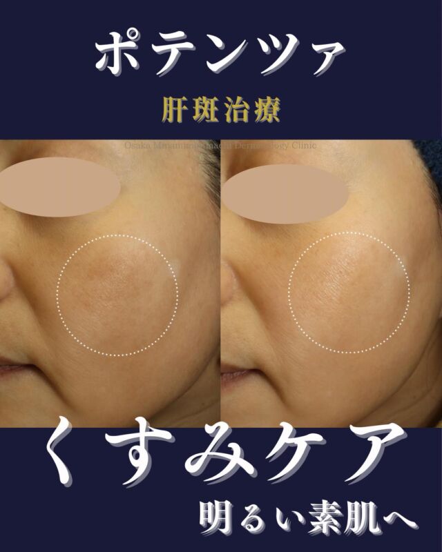 本日は、当院で肝斑治療を受けられた患者様の症例写真をご紹介します。

この患者様は、両頬の肝斑が気になり、他院で肝斑に対して外用・内服治療を受けられておりましたが、十分な改善が得られず当院を受診されました。

当院では、ポテンツァ肝斑モードとエレクトロポレーションを1か月間隔で交互に行い、それぞれ計3回ずつご継続いただいた結果、肝斑やくすみが改善し、お肌全体が 明るく、均一感のある印象のお肌へと変化しました。

【費用】

●ポテンツァ肝斑モード（麻酔込み）

1回 ￥38,500

3回 ￥107,800

●エレクトロポレーション

1回 ￥9,900

3回 ￥28,600

5回 ￥46,750

※いずれも別途、初再診料がかかります。

※治療回数や効果の実感には個人差があります。

※肝斑やくすみは、紫外線や摩擦などの影響を受けやすいため、治療とあわせて日常のUVケア・スキンケアも大切です。

写真の掲載に際しまして、モニターご協力をいただきました患者様には、心より感謝申し上げます。

#ポテンツァ #エレクトロポレーション#肝斑 #くすみ改善 #トラネキサム酸内服治療 #肌トーンアップ #大阪南森町皮ふ科クリニック #症例紹介