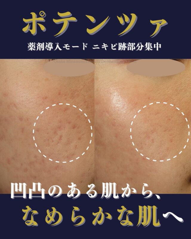 【ニキビ跡治療】
本日は、当院でニキビ跡治療をされている患者さまの症例写真をご紹介いたします。
当院のニキビ治療でニキビが改善した後、凹凸のあるニキビ跡に対してポテンツァ薬剤導入部分集中モードを計6回行いました。

治療前と比較し、凹凸が目立ちにくくなり、肌表面がなだらかになりました。
ニキビ跡にお悩みの方、ポテンツァにご興味がある方
ぜひ一度、当院にご相談ください🍀
────────────
〈費用〉
【 ポテンツァ・薬剤導入モード　部分集中】
2回：￥99.000（1回あたり49.500円）
4回：￥159.200（1回あたり39.800円）
※全顔の1/3以下の範囲が目安です。
※薬剤代・麻酔クリーム代込み

※自費診療の初再診料が別途かかります。
────────────

※写真の掲載にあたり、モニターとしてご協力いただいた
患者さまに心より感謝申し上げます。

#ニキビ跡 #ポテンツァ #美容皮膚科 #大阪南森町皮ふ科クリニック