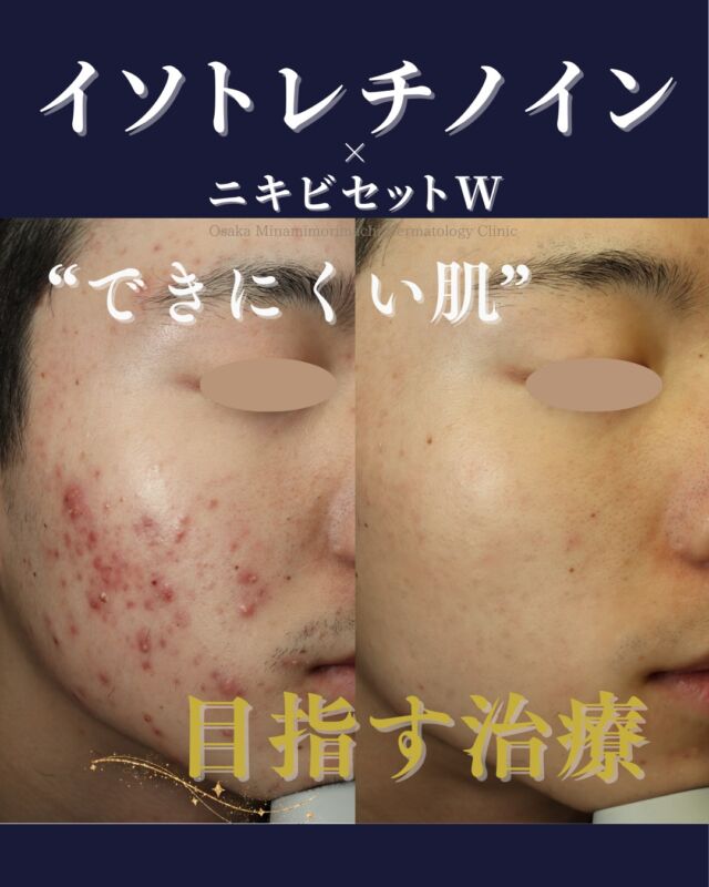 .
.
【ニキビ治療】
本日は、保険診療のみではなかなか改善が乏しかったため、当院でイソトレチノイン内服とレーザー治療を併用された患者さまの症例写真をご紹介します。
当院では、イソトレチノインを6か月間内服し、ニキビセットW（Vビーム＋レーザーフェイシャル）を併用して現在も治療中です。
頑固なにきびが大きく改善し、印象が明るくなりました！

にきびでお悩みの方は、お気軽にご相談ください。
――――――――――――
📍イソトレチノイン20mg（30日分）：¥16,500（税込）
※体重・症状により適正量が異なります
📍ニキビセットW 全顔 1クール（Vビーム1回／レーザーフェイシャル1回）：¥29,700（税込）
・全顔 2クール（Vビーム2回／レーザーフェイシャル2回）：¥57,365（税込）
※別途、初診・再診料がかかります
――――――――――――
写真の掲載に際し、モニターご協力を賜りました患者さまに心より感謝申し上げます。
#ニキビ治療 #イソトレチノイン #大阪南森町皮ふ科クリニック