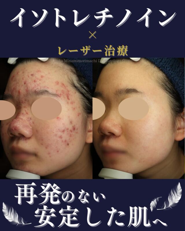【イソトレチノイン内服×レーザー治療】

本日は、当院でニキビ治療をされている患者さまの経過写真をご紹介します。
当初保険診療で治療をされておりましたが、なかなか改善が見られなかったため美容治療へと移行しました。
美容治療としては、
 ・イソトレチノイン6か月内服
 ・レーザーフェイシャル3回
 ・Vビーム1回
 を平行して組み合わせて治療を行いました。
▶ イソトレチノイン
 皮脂分泌を根本から抑制
▶ レーザーフェイシャル
 毛穴・皮脂バランスの改善
▶ Vビーム
 赤み・炎症後紅斑の改善
複合治療により
 「ニキビを減らす」＋「赤みを残さない」＋「再発しにくい肌質へ」
美容治療終了から1年が経過した現在も、安定した肌状態を維持されています✨
ニキビに繰り返し悩んでいる方は、ぜひ一度ご相談ください。

＜費用＞
イソトレチノイン20mg　30日分￥16,500（税込）
※体重により適正量が異なる場合があります。

レーザーフェイシャル　全顔
1回￥16,500（税込）
3回￥48,400（税込）
5回￥77,000（税込）

Vビーム　1回　
全顔　￥19,800（税込）
両頬　￥14,850（税込）
鼻 ￥11,000（税込）
※自費診療の初再診料が別途かかります。

写真の掲載に際しまして、モニターご協力をいただきました患者さまには心より感謝申し上げます。

#ニキビ　#ニキビ治療 #イソトレチノイン #Vビーム　#大阪南森町皮ふ科クリニック