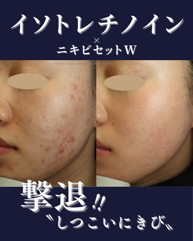 【にきび、にきび跡治療】
本日は、当院でにきび・にきび跡治療をされている患者さまの症例写真をご紹介いたします。
この方は、イソトレチノイン内服開始後、にきび跡に対して「にきびセットW」（Vビームレーザー・レーザーフェイシャル）を継続中です。
治療前と比較し、新しいにきびがほとんどできなくなり、にきび跡が目立ちにくくなりました。
にきび・にきび跡にお悩みの方、イソトレチノインやレーザー治療に興味がある方
ぜひ一度、当院にご相談ください！
────────────
〈費用〉
・ニキビセットW
1クール　29,700円（税込）
（Vビーム全顔1回＋レーザーフェイシャル全顔1回）
2クール　57,365円（税込）
（Vビーム全顔2回＋レーザーフェイシャル全顔2回）

・イソトレチノイン20mg（30日分）
16,500円（税込）
※体重により適正量が異なる場合があります。

※自費診療の初再診料が別途かかります。
────────────
※写真の掲載にあたり、モニターとしてご協力いただいた
患者さまに心より感謝申し上げます。

#にきび＃にきび跡　#イソトレチノイン
#レーザーフェイシャル＃Vビーム
#美容皮膚科
#大阪南森町皮ふ科クリニック