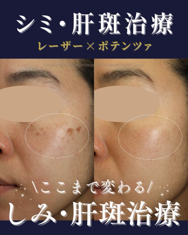 本日は、しみ・肝斑治療を受けられた患者様の症例写真をご紹介します。

こちらの患者様は、左頬の大きなしみと両頬の細かいしみ、くすみを主訴にご来院されました。

診察の結果、両頬にしみ（老人性色素斑）だけでなく、肝斑の合併が認められたため、肝斑悪化のリスクを考慮し、肝斑が重なっている部分のしみは出力を調整の上で、お顔全体のシミに対してシミ取りレーザーを行い、あわせてエレクトロポレーションを組み合わせた「シミ取り放題セットA」で治療を開始しました。

その後は、アフター治療と肝斑治療を兼ねて、シミ取り美白セット（トーニング＋エレクトロポレーション）を月1回、計6回施術。

さらに、ポテンツァ肝斑モードを仕上げとして1回行いました。

また、治療期間を通して内服治療としてシナール・ユベラ・トラネキサム酸を併用し、内側からのケアもあわせて行っております。

その結果、肝斑の大きな悪化なく、気にされていたしみや肝斑、くすみが改善し、お肌全体のトーンアップがみられました。

しみ治療は、しみだけを見て進めるのではなく、肝斑の有無や肌全体の状態をふまえて治療方法を選択することが大切です。

当院では、お一人おひとりのお肌状態に合わせて、カスタマイズした治療をご提案しています。

※治療回数や効果の実感には個人差があります。

※診察の結果、肌状態によっては当日のシミ取り施術をご案内できない場合があります。

※肝斑やくすみは、肌状態やご自宅でのスキンケアの影響も受けやすいため、治療とあわせて紫外線対策、ホームケア、内服の継続も大切です。

お肌の色ムラ、肝斑、くすみ、目元の小ジワが気になる方は、どうぞお気軽にご相談ください。

〈費用〉

●シミ取り放題セットA　￥49,000

・シミ取り放題（全顔）

・エレクトロポレーション 3回

・TA含有ローション 1本

・美容内服 3種

●シミ取り美白セット

（トーニングまたは美肌レーザー＋エレクトロポレーション）

1回　￥18,700

3回　￥53,350

5回　￥86,350

●ポテンツァ肝斑モード（表面麻酔代込み）

1回　￥38,500

3回　￥107,800

※いずれも別途、初再診料がかかります。

写真掲載にあたり、モニターにご協力いただいた患者様へ心より感謝申し上げます。

#シミ取り #肝斑 #くすみ改善 #トラネキサム酸 #大阪南森町皮ふ科クリニック