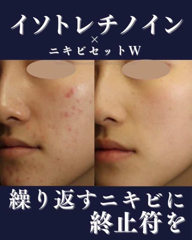 【ニキビ、ニキビ跡治療】
本日は、当院でニキビ・ニキビ跡治療をされている患者さまの症例写真をご紹介いたします。
イソトレチノイン6か月間内服後、ニキビ跡に対して「ニキビセットW」（Vビームレーザー＋レーザーフェイシャル）を1クール行いました。
治療前と比較し、ニキビ・ニキビ跡が改善しています✨

ニキビ・ニキビ跡にお悩みの方、イソトレチノイン・レーザー治療に興味がある方
ぜひ一度、当院にご相談ください🍀
────────────
〈費用〉
・イソトレチノイン20mg（30日分）
16,500円（税込）
※体重により適正量が異なる場合があります。
・ニキビセットW1クール　29,700円（税込）
（Vビーム全顔1回＋レーザーフェイシャル全顔1回）
・ニキビセットW2クール　57,365円（税込）
（Vビーム全顔2回＋レーザーフェイシャル全顔2回）
※自費診療の初再診料が別途かかります。
────────────

※写真の掲載にあたり、モニターとしてご協力いただいた
患者さまに心より感謝申し上げます。

#ニキビ #ニキビ跡 
#イソトレチノイン #レーザーフェイシャル #Vビーム #美容皮膚科 #大阪南森町皮ふ科クリニック