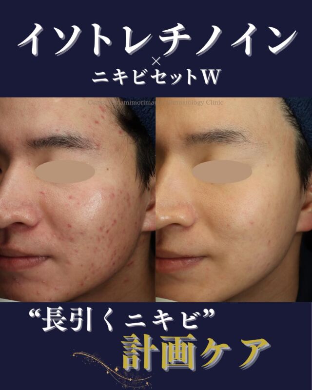 .
【ニキビ治療】
10代の頃からニキビにお悩みだった患者様の症例をご紹介します。
サリチル酸ピーリングとレーザーフェイシャルを交互に行う治療から開始しましたが、新しいニキビが続いていたため、イソトレチノインの内服を開始しました。
その後は、イソトレチノイン内服と並行してニキビ予防とニキビ跡治療を目的に、ニキビセットW（レーザーフェイシャル／Vビーム）を開始。
イソトレチノインで皮脂をコントロールできたことで、ニキビはほぼできない状態となり、ニキビセットＷでニキビ跡が残らず、再発もなく改善しております。
「繰り返すニキビがつらい」
「ニキビ跡も気になる」
そのようなお悩みがある方は、ぜひご相談ください。
――――――――――――
📍イソトレチノイン20mg（30日分）：¥16,500（税込）
※体重・症状により適正量が異なります
📍ニキビセットW 全顔 1クール（Vビーム1回／レーザーフェイシャル1回）：¥29,700（税込）
・全顔 2クール（Vビーム2回／レーザーフェイシャル2回）：¥57,365（税込）
――――――――――――
写真の掲載に際し、モニターご協力を賜りました患者さまに心より感謝申し上げます。
#ニキビ治療 #イソトレチノイン #大阪南森町皮ふ科クリニック