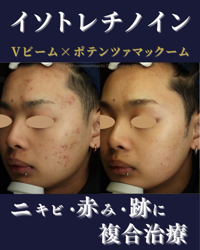 【イソトレチノイン内服 × レーザー × ニキビ跡凹凸治療】

本日は、当院でにきび治療を継続された患者さまの経過写真をご紹介します。
今回の治療内容は、
 ・イソトレチノイン内服
 ・Vビーム 両頬4回
 ・ポテンツァ 薬剤導入モード 部分集中コース4回
にきびを繰り返しにくい肌づくりを目指しながら、赤みや凹凸にも複合的にアプローチしました。
にきびやにきび跡は、お悩みに応じて治療を組み合わせることで、より効果的な改善が期待できます✨
 にきび跡の赤みや凹凸が気になる方は、ぜひ一度ご相談ください🌿

＜費用＞
 イソトレチノイン20mg 30日分　￥16,500（税込）
 ※体重により適正量が異なる場合があります。
Vビーム 1回
 全顔　￥19,800（税込）
 両頬　￥14,850（税込）
ポテンツァ 薬剤導入モード
 にきび跡部分集中コース
 2回　￥99,000（税込）
 4回　￥159,200（税込）
※自費診療の初再診料が別途かかります。

写真の掲載に際しまして、モニターご協力をいただきました患者さまには心より感謝申し上げます。 

#ニキビ　#ニキビ治療 #イソトレチノイン #ポテンツァ　#大阪南森町皮ふ科クリニック