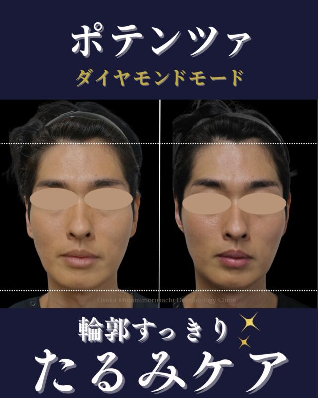 【ポテンツァ ダイヤモンドモード】

本日は、ポテンツァ ダイヤモンドモードを受けた当院の院長の経過写真をご紹介します。

ポテンツァ ダイヤモンドモードは、高周波（RF）の熱エネルギーでお肌の深部にアプローチする施術です。
たるみ感やフェイスラインのもたつきだけでなく、肌のハリ不足や毛穴が気になる方にもおすすめです🌿
また、頬コケが気になる方などやせ型でたるみを気にされている方にもおすすめです。

1回の施術でも、直後からフェイスラインのすっきり感や、チークトップの位置の変化を感じる方もいらっしゃいます。継続して受けていただくことで、ハリ感・キメ・毛穴など、肌質ケアとしての変化も期待できます。

※効果の感じ方には個人差があります。

＜費用＞
ポテンツァ ダイヤモンドモード
500ショット 1回¥39,800
500ショット2回¥66,000
300ショット 1回¥29,800
300ショット 3回¥59,400

※自費診療の初再診料が別途かかります。

#たるみ#肌質改善 #リフトアップ #ポテンツァ #大阪南森町皮ふ科クリニック