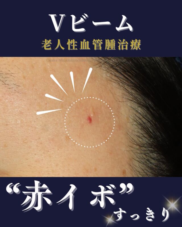 【Vビーム-老人性血管腫治療-】
今回は、こめかみの老人性血管腫(赤イボ)でお悩みになっていた患者さまの症例をご紹介いたします。
Vビームレーザー治療を2回受けられた結果、赤イボがすっきりと改善しました。
Vビームは、血液中の「ヘモグロビン」に吸収されるレーザーで、老人性血管腫、毛細血管拡張など、赤みを伴うさまざまな症状に対して効果が期待されます。
※効果のあらわれ方や必要な治療回数には個人差があります。

＜費用＞
・老人性血管腫(イボ)
1～5個　1個￥4,400
6個目以降　1個￥3,300
11個目以降　1個￥2,200
※自費診療での治療となります。
※別途初診料、再診料がかかります。

写真の掲載に際しまして、モニターご協力をいただきました患者さまには心より感謝申し上げます。

#Vビーム　#老人性血管腫
＃美容皮膚科　
＃大阪南森町皮ふ科クリニック