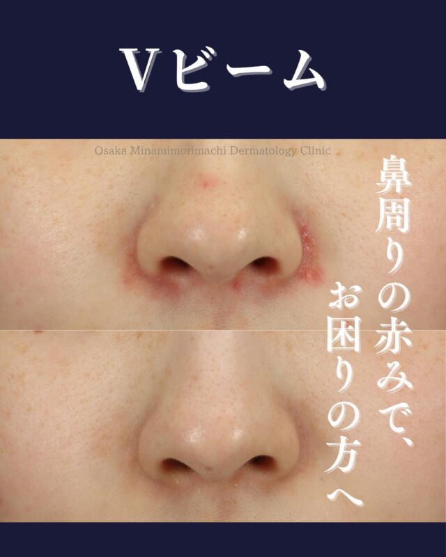.
【鼻周りの赤み治療】
本日は、6年ほど前から鼻周囲の赤みが気になり、他院で脂漏性皮膚炎と言われ長期のステロイド外用や抗真菌薬外用でなかなか改善がみられなかった患者様の症例をご紹介します。
当院では、前医での脂漏性皮膚炎への長期治療による酒さ様皮膚炎と毛細血管拡張の合併と考え、保険診療で抗生剤内服と外用剤により皮膚炎を抑えた後に、鼻周囲の毛細血管拡張の赤みに対してVビームを4回照射しました。
治療後赤みが大きく改善し、ほとんど目立ちにくい状態になり、以降再発を認めておりません。
鼻周りの赤みや、赤ら顔でお悩みの方は、お気軽にご相談ください。

【Vビーム】
全顔：￥19,800
下顔面：￥16,500
両頬：￥14,850
鼻：￥11,000
※別途、初診料または再診料がかかります。
※効果には個人差があります。
写真の掲載にあたり、モニターにご協力いただきました患者様に心より御礼申し上げます。
#赤み治療  #Vビーム #大阪南森町皮ふ科クリニック