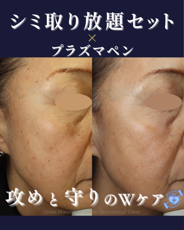 【シミ取り放題セット× プラズマペン】

本日は、当院でシミ・イボ治療をされた患者さまの経過写真をご紹介します。
今回の治療内容は、
・シミ取り美白セット３回コース
・シミ取り放題セット
・プラズマペン

肝斑治療を先行し、その後シミ・イボ治療も並行して行いました。
シミやイボは種類によって適した治療方法が異なるため、まずはお肌の状態をしっかり確認し、必要に応じて治療を組み合わせることが大切です✨
「シミだと思っていたらイボだった」
「肝斑があるため、すぐにレーザー治療ができない」
というケースもあります。
当院では、患者さまのお肌の状態に合わせて治療をご提案しております。
シミ・イボ・肝斑でお悩みの方は、ぜひ一度ご相談ください🌿

＜費用＞
■ シミ取り放題セット　￥29,700～
　シミ取り放題+エレクトロポレーション2-3回、内服薬、化粧水(セットにより内容が異なります)

■ シミ取り美白セット
 トーニングまたは美肌レーザー＋エレクトロポレーション
 ※ただいまキャンペーン中✨
・1回　￥18,700 → ￥17,820
・3回　￥53,350 → ￥49,720
・5回　￥86,350 → ￥77,770

■ プラズマペン
 基本料金（6か月に1回）　￥5,500
【SK／いぼ／アクロコルドン】
 ・2mm未満　￥2,200／個
 ・2〜4mm　￥4,400／個
 ・5〜7mm　￥7,700／個
 ・8〜10mm　￥11,000／個
 ・11mm以上　1mm追加ごとに￥1,100

※すべて税込価格です。
※自費診療の初診料・再診料が別途かかります。

写真の掲載に際しまして、モニターご協力をいただきました患者さまには心より感謝申し上げます。
#シミ取り放題　#シミ取り　#イボ治療　#プラズマペン　#大阪南森町皮ふ科クリニック