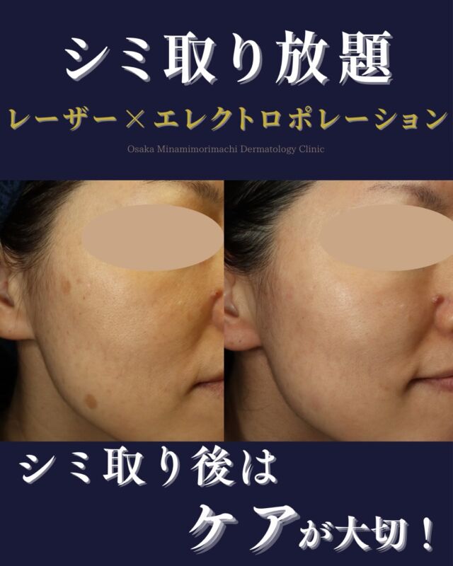 本日は、当院でシミ取り美白セット（トーニング+エレクトロポレーション）とシミ取り放題セットを施術された患者様の症例写真をご紹介します。
こちらの患者様は、お顔のシミやくすみが気になるとのことでご来院されました。
まずは、肝斑やくすみに対してシミ取り美白セット数回施術。
トーニングで肝斑やくすみにやさしくアプローチし、エレクトロポレーションでお肌を冷却しながら美容成分を導入することで、お肌を整えながら治療を進めていきました。
その後、肌状態が好転してきたことを確認した上で、シミ取り放題セットにて気になるシミへの照射と、エレクトロポレーションを併用し、
照射後のお肌を冷却しながら美容成分を導入しダメージの軽減を行いました。
シミ取りレーザー後は一時的に赤みやほてり、色素沈着（PIH：炎症後色素沈着）が起こることがあるため、照射後のお肌をやさしく整えながら治療を行っています。
その結果、気になっていたシミが目立ちにくくなり、お肌全体もより明るい印象になりました🌟

また、治療期間を通してシナール・ユベラ・トラネキサム酸の内服も併用し、内側からのケアもあわせて行っております。
肝斑やくすみは、肌状態や紫外線、ご自宅でのスキンケアの影響も受けやすいため、治療とあわせて紫外線対策・ホームケア・内服の継続も大切です。

シミ治療は、レーザーを当てるだけでなく、肌状態を整えながら進めることが大切です。お一人おひとりのお肌に合わせて、
治療をご提案いたします。

※治療回数や効果の実感には個人差があります。
※診察の結果、肌状態によっては当日のシミ取り施術をご案内できない場合があります。

＜費用＞
●シミ取り放題セットD
¥29,700
・シミ取り放題（全顔）
・エレクトロポレーション 2回

●シミ取り美白セット
（トーニングまたは美肌レーザー+エレクトロポレーション）
1回 ¥18,700
3回　¥53,350
5回　¥86,350
※いずれも別途、初再診料がかかります。

写真掲載にあたり、モニターにご協力いただいた患者様へ心より感謝申し上げます。

#シミ取り#肝斑#くすみ改善#トラネキサム酸#大阪
南森町皮ふ科クリニック