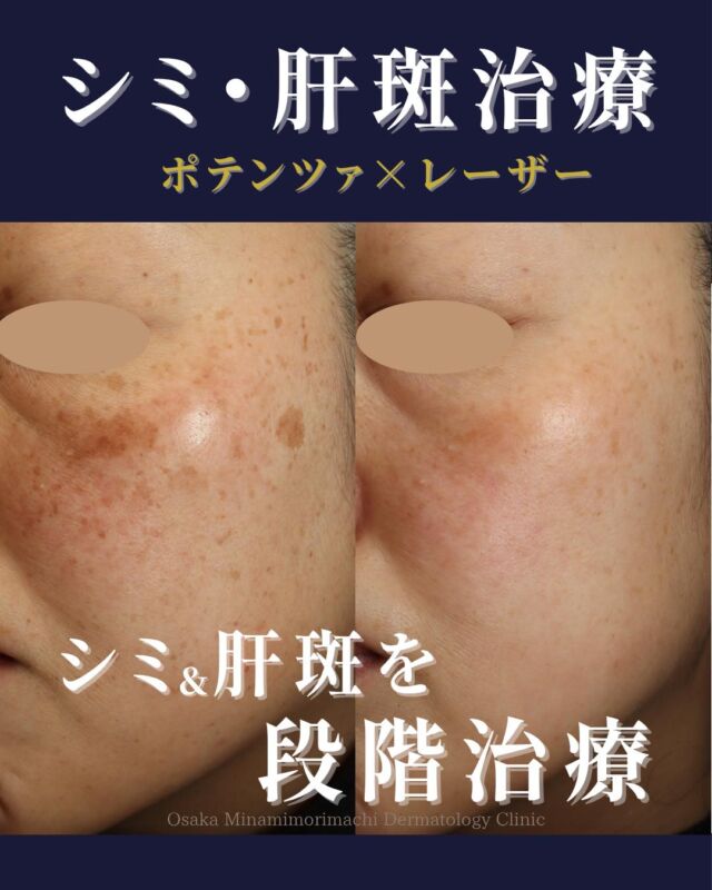 本日は、シミ・肝斑治療を受けられた患者様の症例写真をご紹介します。
こちらの患者様は、趣味による日焼けの機会が多く、両頬のそばかすとシミを主訴にご来院されました。
診察の結果、両頬にシミ（老人性色素斑）・そばかす（雀卵斑）に加え、肝斑の合併が認められました。
そのため、まずは肝斑を落ち着かせる治療として、ポテンツァ肝斑モードとエレクトロポレーションから治療を開始しました。
その後、肝斑が落ち着いてきたタイミングでシミ取り放題セットAを行い、アフター治療と肝斑治療を兼ねて、シミ取り美白セット（トーニング＋エレクトロポレーション）とポテンツァ肝斑モードを月1回の頻度で交互に施術しました。
また、治療期間中は内服治療として、シナール・ユベラ・トラネキサム酸を併用し、内側からのケアもあわせて行っています。
その結果、気にされていたしみや肝斑に改善がみられました。
しみ治療は、しみだけを見て進めるのではなく、肝斑の有無や肌全体の状態をふまえて、治療方法を選択することが大切です。
当院では、お一人おひとりのお肌状態に合わせて、カスタマイズした治療をご提案しています。
※治療回数や効果の実感には個人差があります。
※診察の結果、肌状態によっては当日のシミ取り施術をご案内できない場合があります。
※肝斑やくすみは、肌状態やご自宅でのスキンケアの影響も受けやすいため、治療とあわせて紫外線対策・ホームケア・内服の継続も大切です。
お肌の色ムラ、肝斑、くすみ、しみが気になる方は、どうぞお気軽にご相談ください。
〈費用〉
●シミ取り放題セットA　￥49,000
・シミ取り放題（全顔）
・エレクトロポレーション 3回
・TA含有ローション 1本
・美容内服 3種
●シミ取り美白セット
（トーニングまたは美肌レーザー＋エレクトロポレーション）
1回　￥18,700～
●ポテンツァ肝斑モード（表面麻酔代込み）
1回　￥38,500～
●エレクトロポレーション
1回　￥9,900～

※いずれも別途、初再診料がかかります。
写真掲載にあたり、モニターにご協力いただいた患者様へ心より感謝申し上げます。

#シミ取り #肝斑 #ポテンツァ  #大阪南森町皮ふ科クリニック