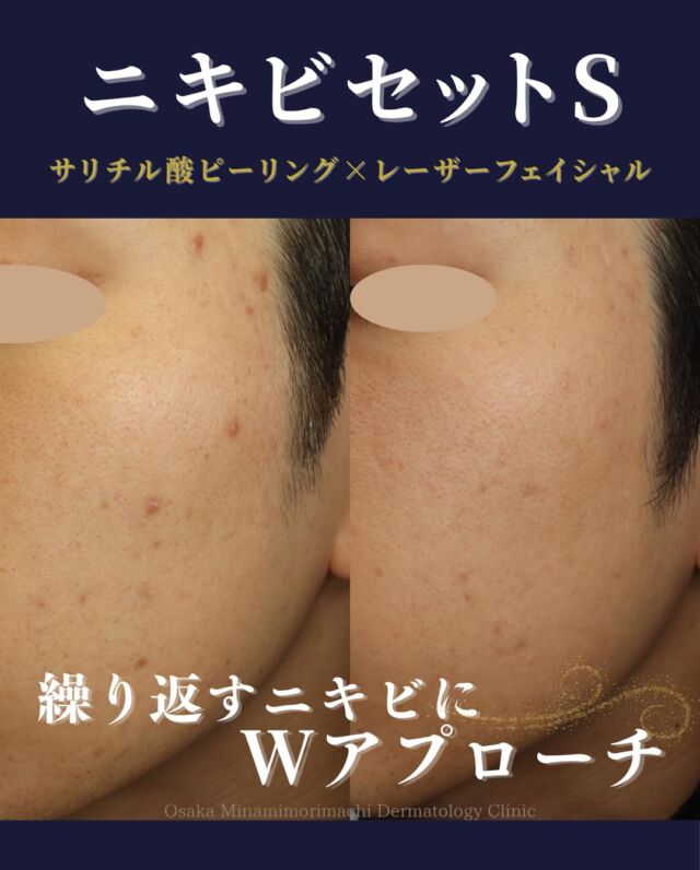 【ニキビ治療】
本日は、繰り返すにきびに対して治療をされた患者さまの症例写真をご紹介します。
この患者さまは、保険診療のにきび治療を受けておられましたが、再発を繰り返されていたため、自費治療への切り替えをご希望されました。
にきびができにくい肌状態にするために「にきびセットS」（サリチル酸ピーリング+レーザーフェイシャル）を計5回行いました。
にきびの改善がみられ、患者さまご本人も新しいニキビができにくくなったことを実感されています。

レーザー等の施術はお得なセットもございます✨
にきびでお悩みの方は、ぜひ当院へご相談下さい。

＜費用＞
・ニキビセットS全顔　￥21,560～
（サリチル酸ピーリング+レーザーフェイシャル）

※自費診療の初再診料が別途かかります。

写真の掲載に際しまして、モニターにご協力をいただきました患者さまには心より感謝申し上げます。

＃にきび治療
＃サリチル酸ピーリング
＃レーザーフェイシャル　
＃美容皮膚科
＃大阪南森町皮ふ科クリニック