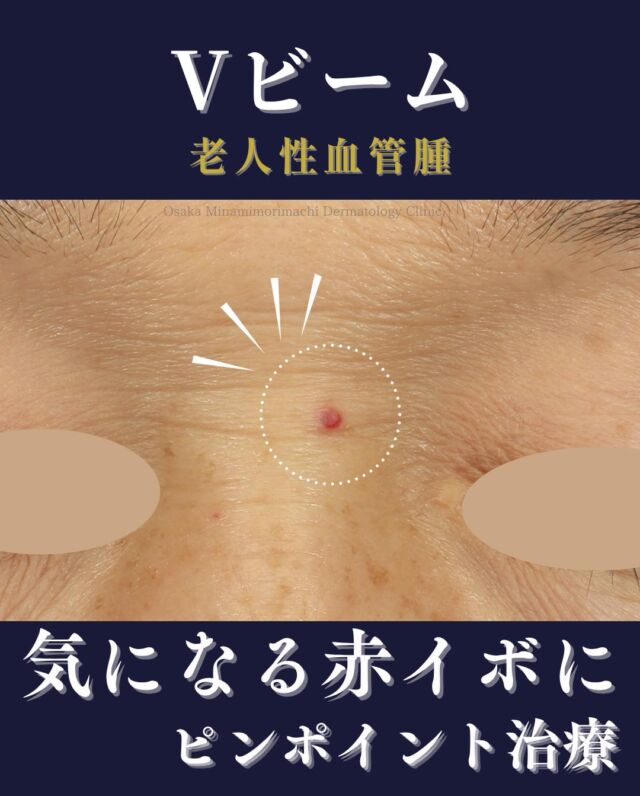 .
【Vビーム-老人性血管腫-】
今回は、眉間の老人性血管腫(赤イボ)でお悩みになっていた患者さまの症例をご紹介いたします。
Vビームレーザー治療を3回受けられた結果、赤イボがすっきりと改善しました。
Vビームは、血液中の「ヘモグロビン」に吸収されるレーザーで、老人性血管腫、毛細血管拡張など、赤みを伴うさまざまな症状に対して効果が期待されます。
※効果のあらわれ方や必要な治療回数には個人差があります。

＜費用＞
・老人性血管腫(イボ)
1～5個　1個￥4,400
6個目以降　1個￥3,300
11個目以降　1個￥2,200
※自費診療での治療となります。
※別途初診料、再診料がかかります。

写真の掲載に際しまして、モニターご協力をいただきました患者さまには心より感謝申し上げます。

#Vビーム　#老人性血管腫
＃美容皮膚科
＃大阪南森町皮ふ科クリニック