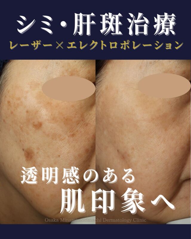 本日は、シミ・肝斑治療を受けられた患者様の症例写真をご紹介します。
こちらの患者様は、両頬のシミを主訴にご来院されました。
診察の結果、両頬にシミ（老人性色素斑）・肝斑が認められました。
そのため、まずは肝斑を落ち着かせる治療として、シミ取り美白セット（トーニング+エレクトロポレーション）から治療を開始しました。
その後、肝斑が落ち着いてきたタイミングでシミ取り放題セットを行い、アフター治療と肝斑治療を兼ねて、シミ取り美白セット（トーニング＋エレクトロポレーション）を施行し、残ったシミに対して2度目のシミ取り放題セットを施行しました。
また、治療期間中は内服治療として、シナール・ユベラを併用し、内側からのケアもあわせて行っています。
その結果、気にされていたしみや肝斑に改善がみられました。
当院では、お一人おひとりのお肌状態に合わせて、カスタマイズした治療をご提案しています。
※治療回数や効果の実感には個人差があります。
※診察の結果、肌状態によっては当日のシミ取り施術をご案内できない場合があります。
※肝斑やくすみは、肌状態やご自宅でのスキンケアの影響も受けやすいため、治療とあわせて紫外線対策・ホームケア・内服の継続も大切です。
お肌の色ムラ、肝斑、くすみ、しみが気になる方は、どうぞお気軽にご相談ください。
〈費用〉
●シミ取り放題セットB　￥44,800
・シミ取り放題（全顔）
・エレクトロポレーション 3回
・TA含有ローション 1本
●シミ取り美白セット
（トーニングまたは美肌レーザー＋エレクトロポレーション）
1回　￥18,700～
●内服2種　￥3,520

※いずれも別途、初再診料がかかります。
写真掲載にあたり、モニターにご協力いただいた患者様へ心より感謝申し上げます。

#シミ取り #肝斑 #トーニング  #エレクトロポレーション #大阪南森町皮ふ科クリニック