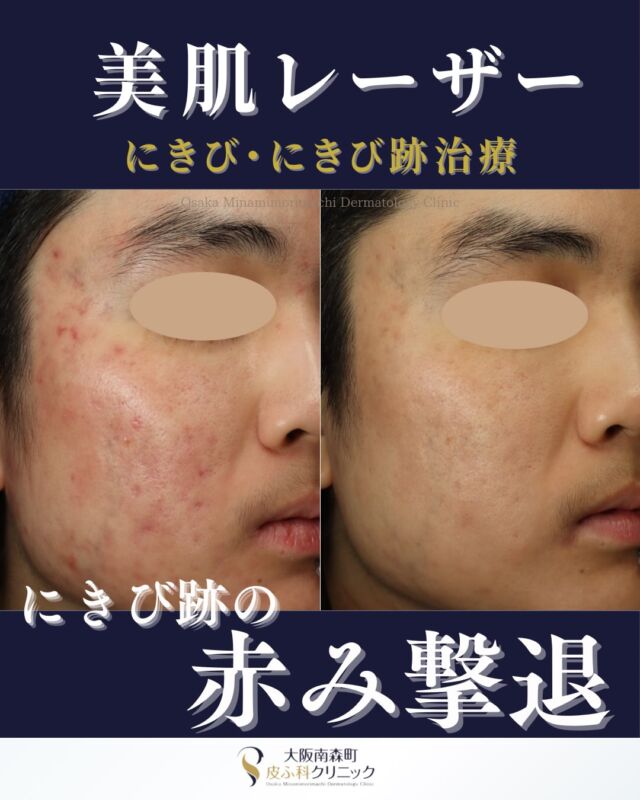 本日は、当院でニキビ跡の赤みに対して、美肌レーザーを計5回された患者様の症例写真をご紹介します。

学生の頃からニキビに悩まれ、これまで保険治療やダーマペンなど、他院でさまざまな治療を受けてこられた患者様です。
他院にてダーマペンを複数回受けられてニキビ跡の凹凸は少し改善したものの強い赤みが残り、その後も他院にてVビームレーザーで赤みに対する治療を10回程度継続されていました。ある程度は改善したものの、満足のいく状態までは改善できず、さらなる改善を希望され当院へご来院されました。

当院では、残っていたニキビ跡の赤みに対して美肌レーザーを開始しました。
治療を重ねることで赤みがさらに目立ちにくくなり、肌全体の質感もなめらかな印象になりました。
美肌レーザーは、レーザーによる温熱作用で真皮のコラーゲン産生を促し、ハリ・ツヤを与えるとともに、ニキビ跡の赤みの改善も期待できる施術です。
温かいシャワーを浴びているような感覚で、痛みやダウンタイムがほとんどないため、日常生活への影響を抑えながら治療を続けていただけます。
ニキビの炎症が続くと、赤みだけでなく凹み（クレーター）などのニキビ跡につながることもあるため、できるだけ早い段階から適切な治療を行うことが大切です。
ニキビやニキビ跡の赤みでお悩みの方、美肌レーザーに興味のある方は、ぜひ当院へご相談ください。

＜料金＞
・美肌レーザー　１回　￥8,800（税込）
※別途、自費診療の初再診料がかかります。

#ニキビ跡 #ニキビ跡の赤み
#トライビームプレミアム
＃大阪南森町皮ふ科クリニック