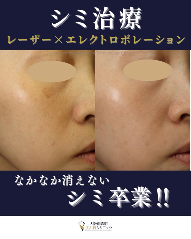 本日は、シミ・くすみ治療を受けられた患者様の症例をご紹介します。
こちらの患者様は、右頬のシミが気になり、他院で数回シミ治療を受けられていましたがシミが消えず、くすみの悪化を主訴にご来院されました。
まずは日焼けによるダメージやくすみの改善として、シミ取り美白セット（トーニング＋エレクトロポレーション）から治療を開始しました。
その後、くすみが落ち着いてきたタイミングでシミ取り放題セットを行い、さらにアフターケアとして、シミ取り美白セット（トーニング＋エレクトロポレーション）を継続しました。
その結果、くすみと気にされていたシミの改善がみられました。
当院では、お一人おひとりのお肌の状態に合わせて、治療内容を組み合わせながらご提案しています。
※治療回数や効果の実感には個人差があります。
※診察の結果、肌状態によっては当日のシミ取り施術をご案内できない場合があります。
※肝斑やくすみは、肌状態やご自宅でのスキンケアの影響も受けやすいため、治療とあわせて紫外線対策・ホームケア・内服の継続も大切です。
お肌の色ムラ、肝斑、くすみ、しみが気になる方は、どうぞお気軽にご相談ください。
〈費用〉
●シミ取り放題セットB　￥44,800
・シミ取り放題（全顔）
・エレクトロポレーション 3回
・TA含有ローション 1本
●シミ取り美白セット
（トーニングまたは美肌レーザー＋エレクトロポレーション）
1回　￥18,700～

※いずれも別途、初再診料がかかります。
写真掲載にあたり、モニターにご協力いただいた患者様へ心より感謝申し上げます。

#シミ取り #くすみ #トーニング #大阪南森町皮ふ科クリニック