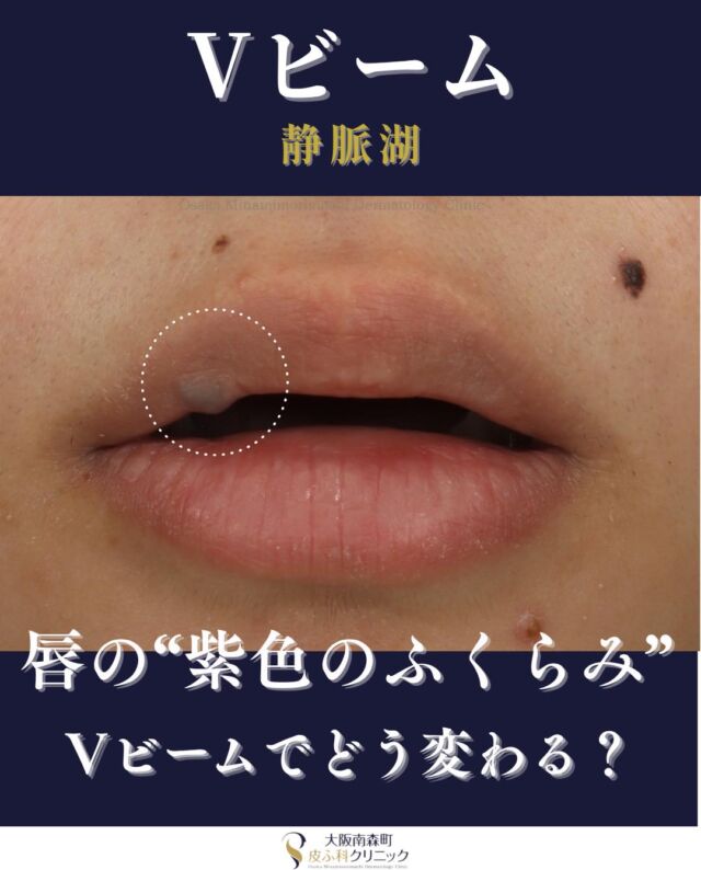 .
【Vビーム-静脈湖治療-】
本日は、当院で唇の静脈湖に対してVビームで治療をされた患者さまの症例をご紹介します。

静脈湖は、顔や唇、耳などにできる青紫色のふくらみで、加齢や紫外線、外傷（唇を噛むなど）が原因とされています。
この患者様は、Vビームを1回照射した結果、上唇の静脈湖が大幅に目立ちにくくなりました。

顔や唇の静脈湖にお悩みの方、お気軽にご相談ください🍃

＜費用＞
Vビーム静脈湖１個：￥11.000（税込）
※必要な治療回数や効果には個人差があります。

＃静脈湖　＃Vビーム
＃美容皮膚科
＃大阪南森町皮ふ科クリニック